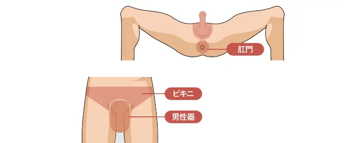 ゴリラクリニックのVIO脱毛部位