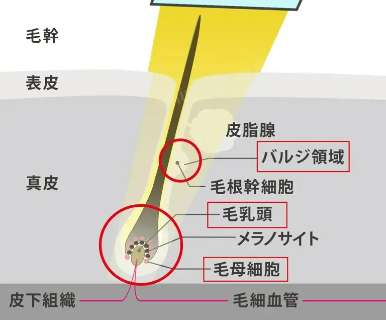 熱破壊式の脱毛のしくみ